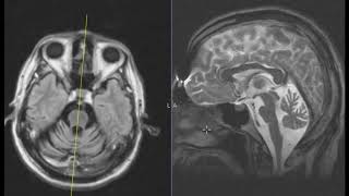 Slurred speech and difficulty walking worse over 6 months [upl. by Delisle818]