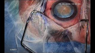 An Intumescent cataract with shallow AC [upl. by Nella]