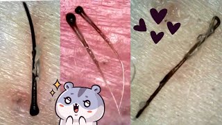 Ingrown Hair Follicle Plucks Removal of Stubborn Hairs  Super Satisfying Roots and Sheaths [upl. by Ybrad]