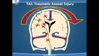 Traumatic Brain Injury  Part 3 [upl. by Hector]