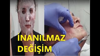 YÜZ DOLGUSU İLE DÜNYA GÜZELİ OLDU [upl. by Assennav]