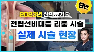 리줌2화직접 시술하는 장면 공개 2023 신의료기술 리줌 자세히 보기 전립선비대증시술 [upl. by Ardnaxela]