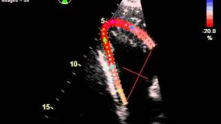 RIGHT VENTRICLE MYOCARDIAL INFARCTION STRAIN [upl. by Fawna]