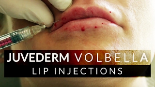 Lip Filler Juvederm Volbella Treatment [upl. by Atteuqal]