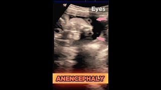 ANENCEPHALY  25wks Pregnancy  Baby without Head ultrasound pregnancy congenital baby [upl. by Alper176]