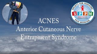 ACNES abdominal cutaneous nerve entrapment syndrome [upl. by Ivek]