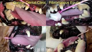 FIBROMATOUS EPULIS 치은종 [upl. by Kazue]