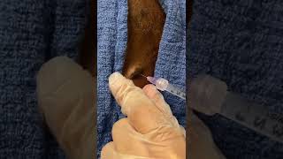 Seborrheic Keratosis treated with Dermal Curette [upl. by Enitsirc]