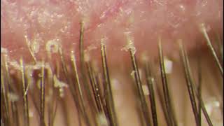 Demodex Eye Infection  Extraction of Mite Placed on Eyelid [upl. by Edsel]