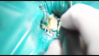 Endodontical germ reduction [upl. by Memberg21]