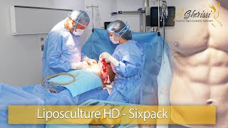 Abdominoplastie avec une Liposculture HD Sixpack et un lipofilling cernes [upl. by Isador]