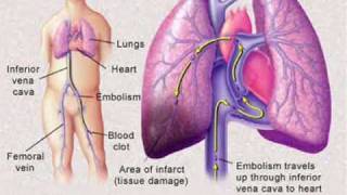 Pulmonary Embolism [upl. by Fasta]