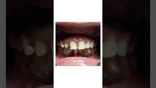 Veneers at the rescueFor discolored old restoration on teeth [upl. by Uhn830]