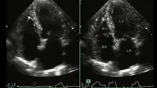 Ebsteins Anomaly in an Old Lady [upl. by Bonar]