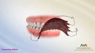 Orthodontic Retainers Hawley Clear and Permanent [upl. by Rubinstein]