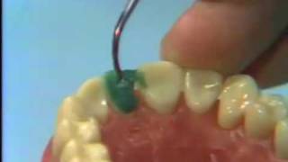 Dental Anatomy Waxing a Maxillary Central Incisor [upl. by Llesig]