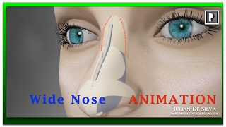 Rhinoplasty Animation  How can a Wide nose be narrowed [upl. by Castle]