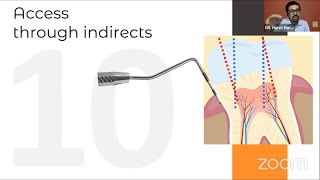 ACCESS OPENING in ROOT CANAL TREATMENT  Clinical Tips and Tricks [upl. by Mckinney]