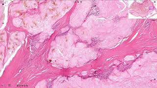 Gout  Histopathology Joints [upl. by Sausa28]