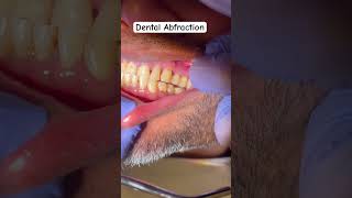 GRINDING TEETH EROSION [upl. by Ettenal254]