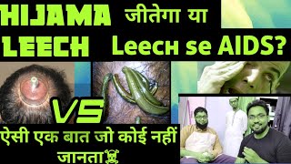 Hijama Therapy Vs Leech Therapy  कौन न है सबका बाप कौन है सबसे ज्यादा effective [upl. by Scharff]