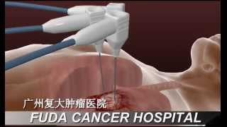 Cancer Cryosurgical Ablation [upl. by Ailerua227]