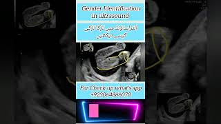 Gender Identification Male or Female in ultrasound [upl. by Torhert]