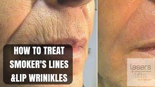 How to treat upper lip wrinkles and smokers lines [upl. by Shane]