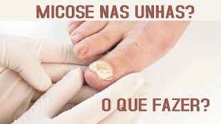 Onicomicoses  Micose nas unhas O que fazer [upl. by Llenrac700]