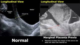 Obstetric Ultrasound Normal Pregnancy Vs Placenta Previa  LowLying Marginal Partial Complete [upl. by Hotchkiss835]