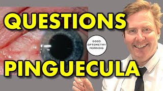 PINGUECULA QUESTIONS ANSWERED by YouTube Eye Doctor amp Optometrist yellow spot on eye explained [upl. by Pontias]