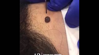 mole removal with Plasmage ®  by noorjan center [upl. by Nedyaj]