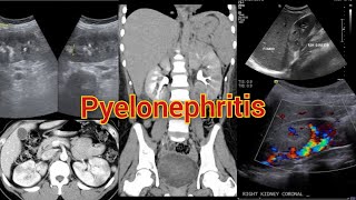 Radiology Viva Case  05  Pyelonephritis Complicated by Pseudoaneurysm medical radiology doppler [upl. by Anailuig]