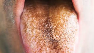 What is Hairy Tongue Causes Symptoms and Treatment [upl. by Esiuqcaj]