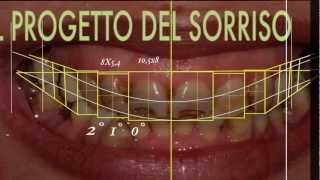 Cambiare laspetto del sorriso con faccette dentali  SMILE DESIGN [upl. by Aihsakal]