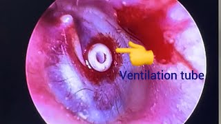 Ventilation tube insertion Part2 [upl. by Eselrahc]