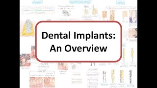 Implants An Overview Osseointegration Types of Bone One stage vs Two stage surgery [upl. by Bandler]