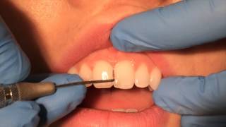 Periodontal Probing [upl. by Akers]