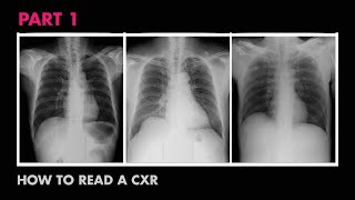 Anatomy of a Chest XRay  How to Read a Chest XRay Part 1 [upl. by Ytirahc328]