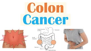 Colon Cancer CRC Risk Factors Pathogenesis Symptoms Diagnosis Staging Treatment [upl. by Lyrret808]