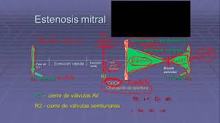 estenosis mitral 2 [upl. by Kenta]