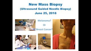 New Mass Biopsy [upl. by Sweatt]