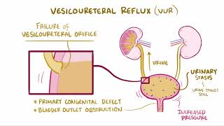 VIDEO Acute pyelonephritis urinary tract infection causes symptoms amp pathology [upl. by Norrabal]