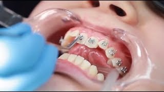 Como se Ponen los Brackets  Instalación de Frenillos Paso a Paso  Ortodoncia [upl. by Saffier968]