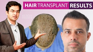 Hair Transplant Before and After Results Grade 6  5000 Grafts at Medispa  Dr Suneet Soni [upl. by Nuoras]