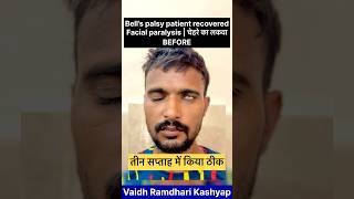 तीन सप्ताह में किया ठीक Bell’s palsy patient recovered  Facial paralysis bellspalsy paralysed [upl. by Jeramey]