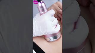 How to use cavitation radio frequency machine for weight loss treatment [upl. by Dlopoel]