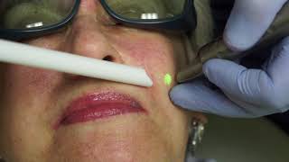 Dr Acula Facial Rejuvenation with the Fotona Lightwalker Laser and IPRF [upl. by Blackstock818]