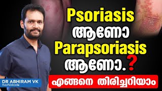 Psoriasis ആണോ Parapsoriasis ആണോഎങ്ങനെ തിരിച്ചറിയാം  Psoriasis Malayalam Treatment  Dr Ahiram VK [upl. by Regen]