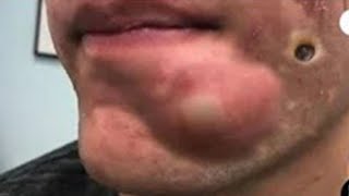 Big Cystic Acne Blackheads Extraction Blackheads amp Milia Whiteheads Removal Pimple Popping  5240 [upl. by Susana]